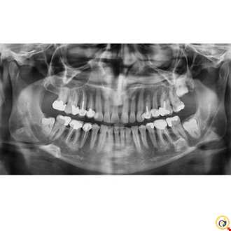 رادیوگرافی کامل دندان | سونوگرافی و رادیولوژی مروارید ری